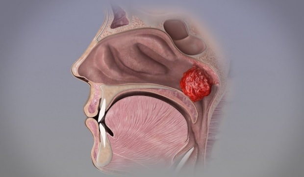 Qu'est-ce que le cancer du nez (nasopharynx)? Quels sont les symptômes du cancer chez les adolescents? Traitement du cancer chez les adolescents ...