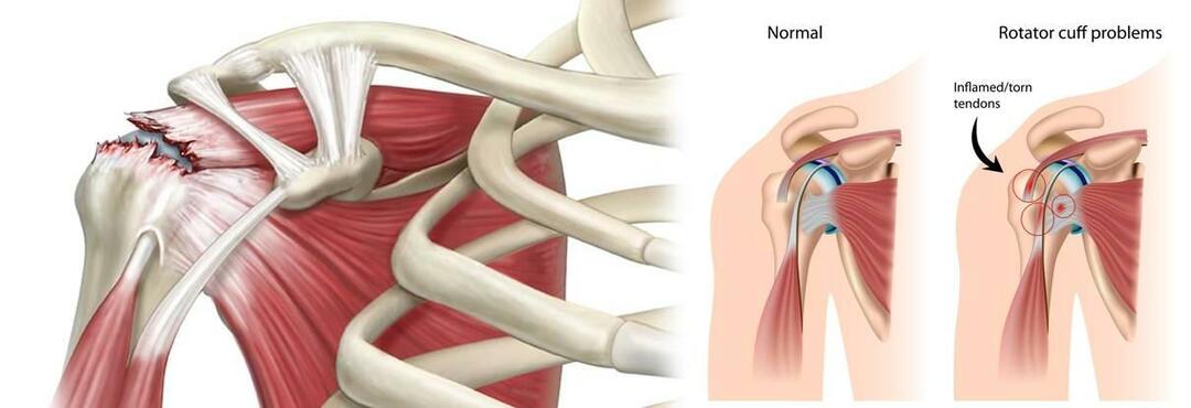 Pourquoi une déchirure de l'épaule se produit-elle? Comment traite-t-on une déchirure de l’épaule ?