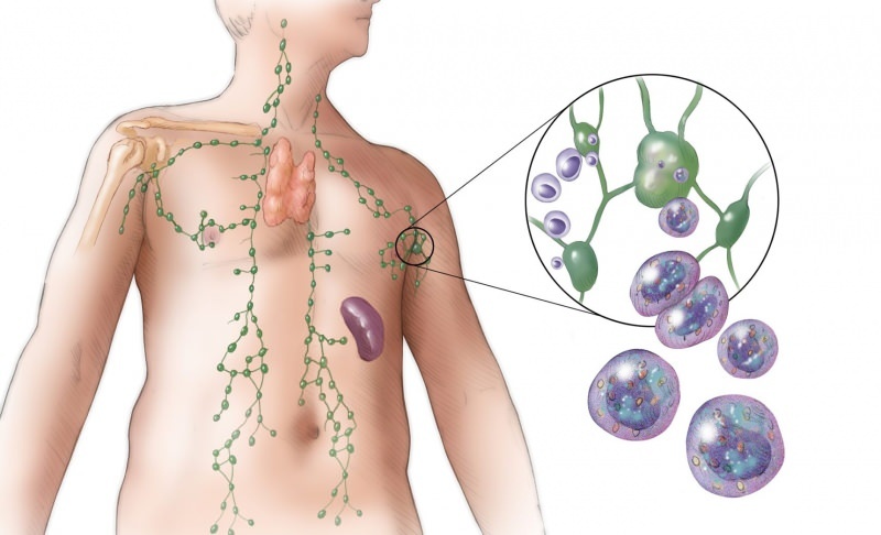 Qu'est-ce que le cancer du lymphome (lymphome)? Quels sont les symptômes du cancer de la lymphe et existe-t-il une méthode de traitement?