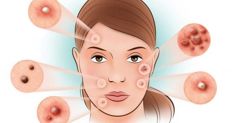 Comment traite-t-on l'acné?