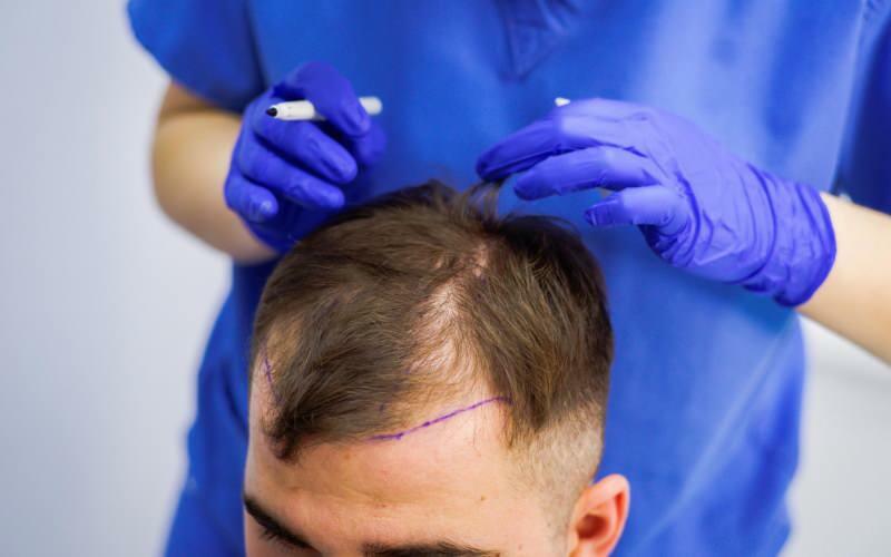 Est-il permis de transplanter des cheveux dans le traitement de la perte de cheveux? Qu'est-ce que les cheveux prothétiques? Les prothèses capillaires gênent-elles le ghusl?